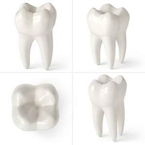 Stages of dental caries and dental implant